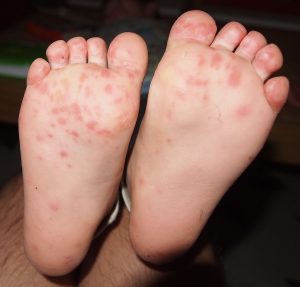 hand, foot, and mouth disease rash