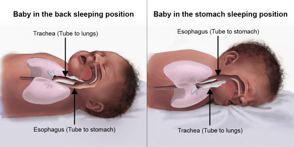 Anatomy of trachea and esophagus contrasted in baby sleeping back position and baby sleeping in stomach position