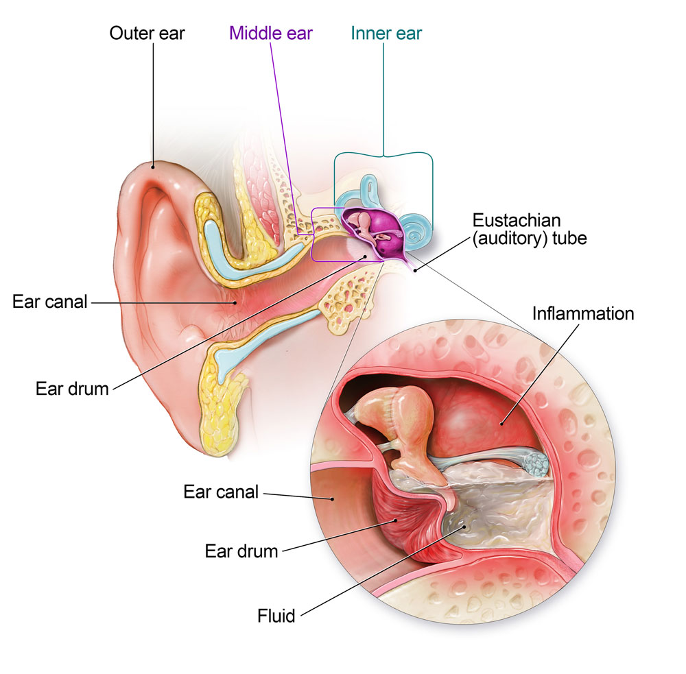 diagrama de anatomía del oído con infección