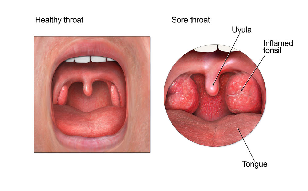 Dolor de garganta comparado con la garganta sana